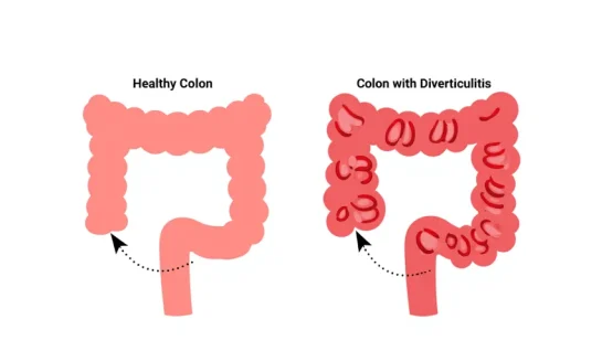 Combien de temps dure une crise de diverticulite : guide complet pour comprendre les symptômes et la durée